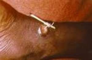Yendi District ranks fourth in guinea worm cases